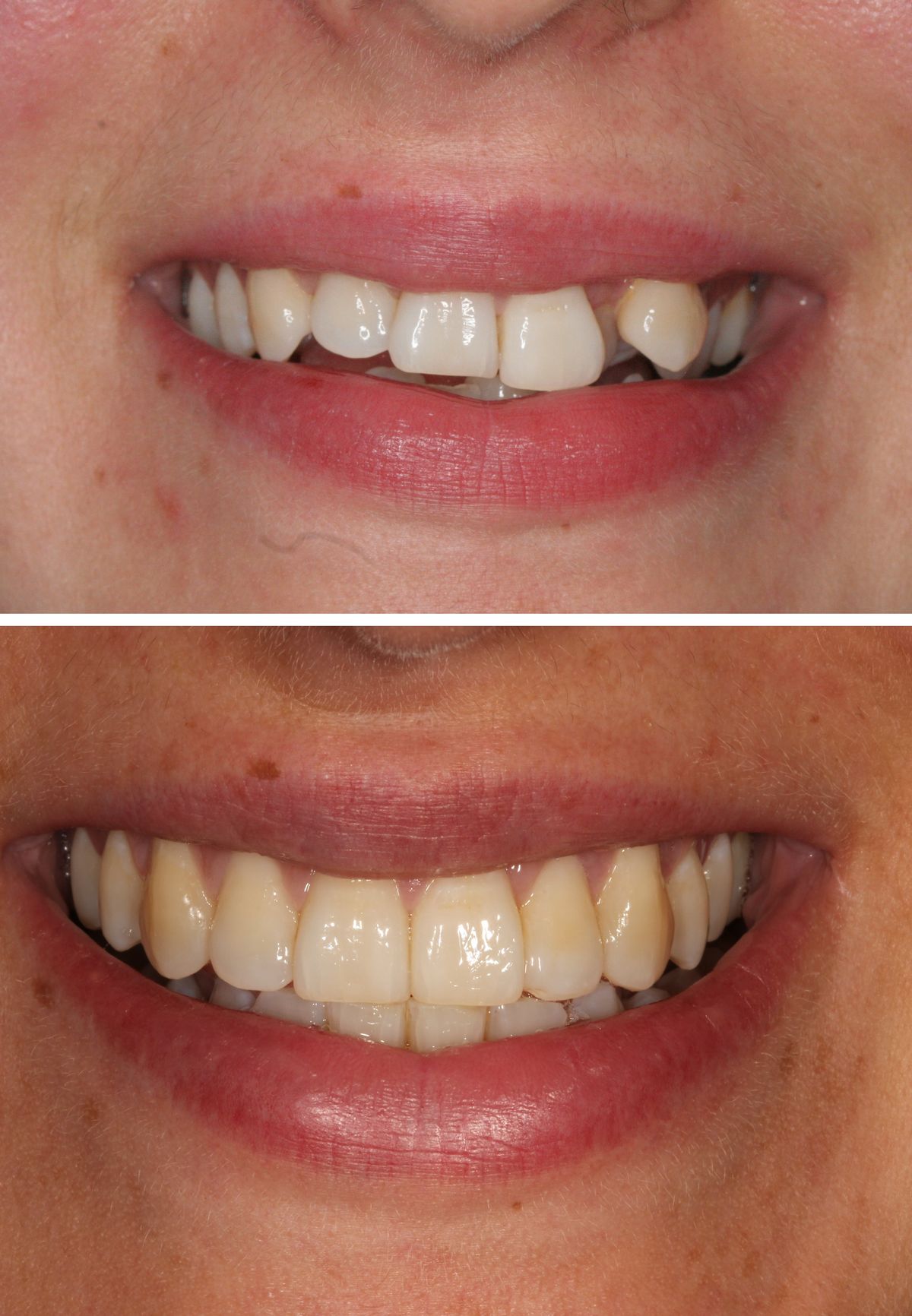Invisalign Results
