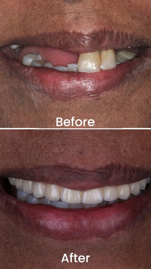 Smile Transformation Case 01