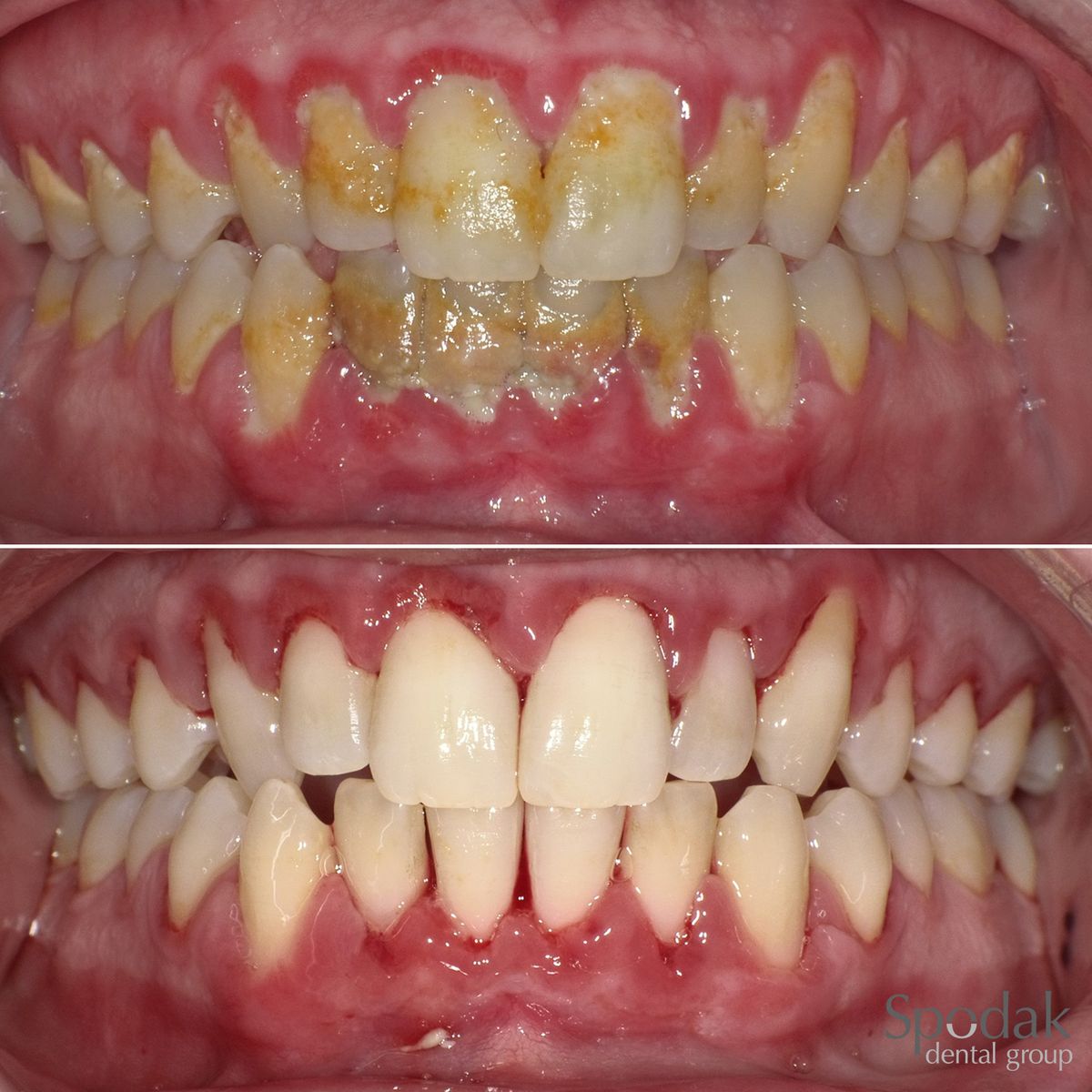 gum treatment